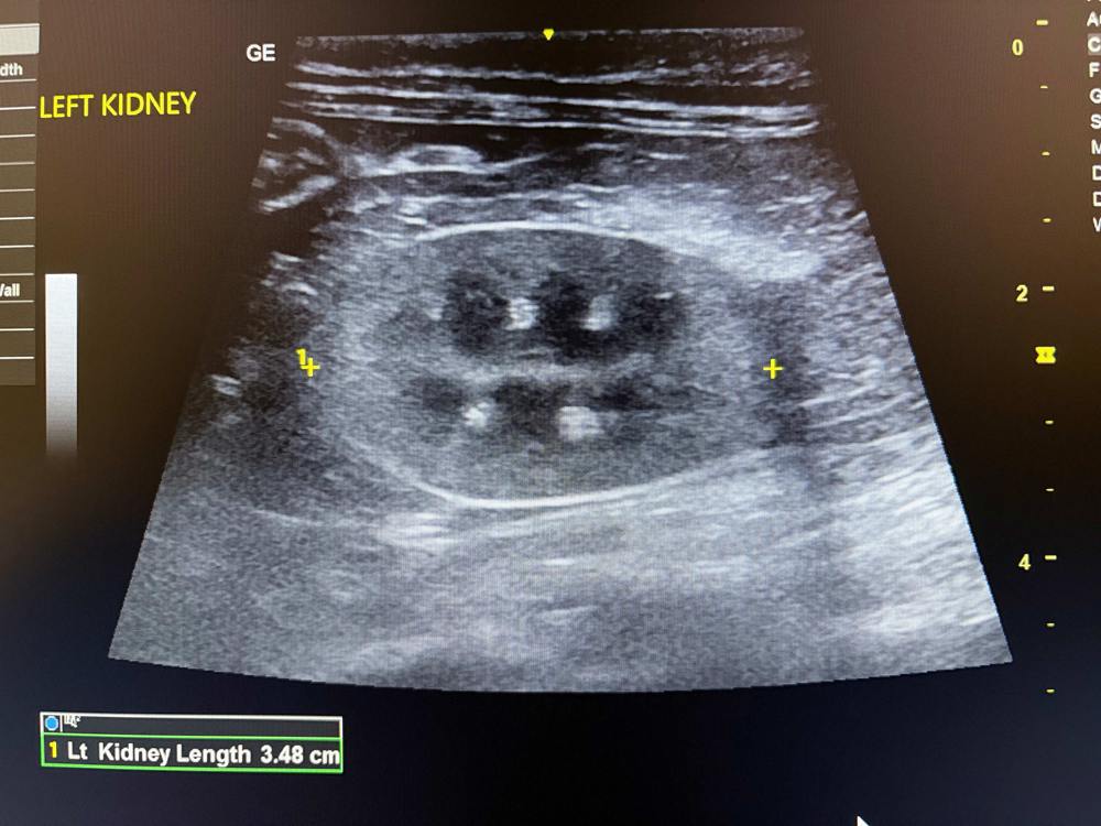 Bart US Kidney