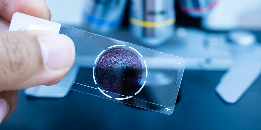 Primer plano de una mano humana sosteniendo un portaobjetos de microscopio con células teñidas de púrpura y un microscopio en el fondo.