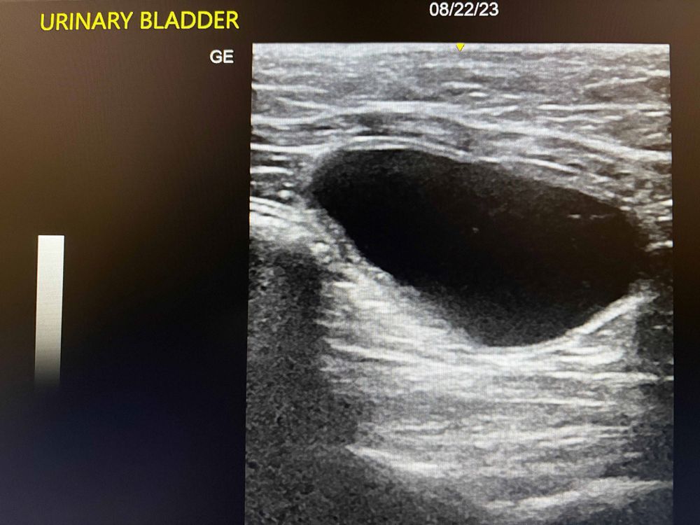 Bart Bladder Ultrasound