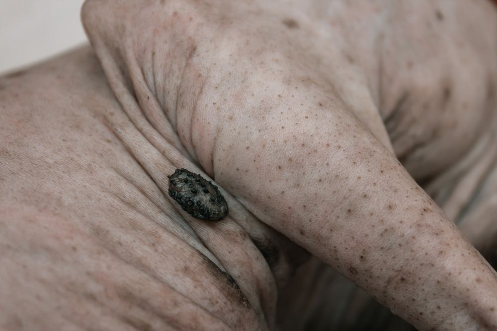 Close up photos of a hairless Sphinx cat with a black round skin growth near the armpit.