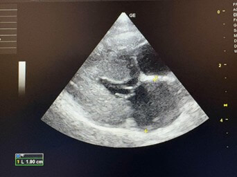left atrium