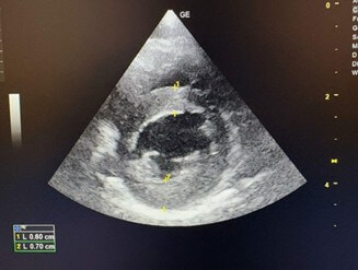 sonogram image of the heart 1