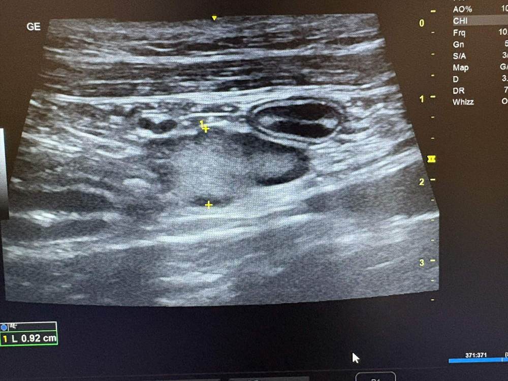 Black and white ultrasound image showing a cat’s abdominal lymph node, a long thin grey structure with abnormal black bordering.
