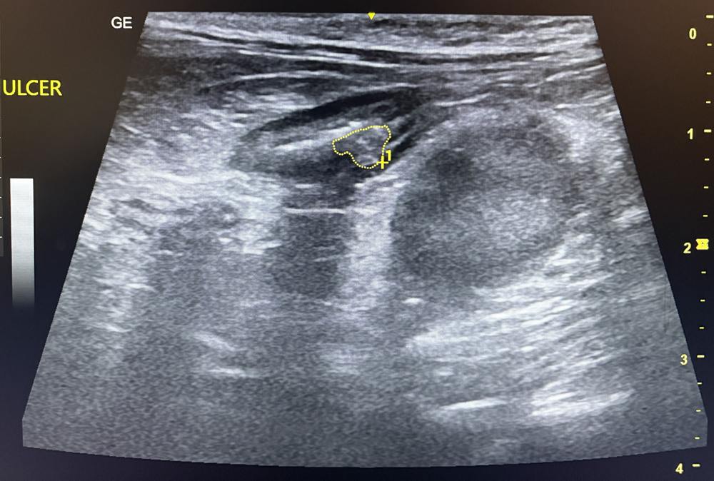 Black and white ultrasound image showing an ulcer in the wall of the small intestine of a cat.
